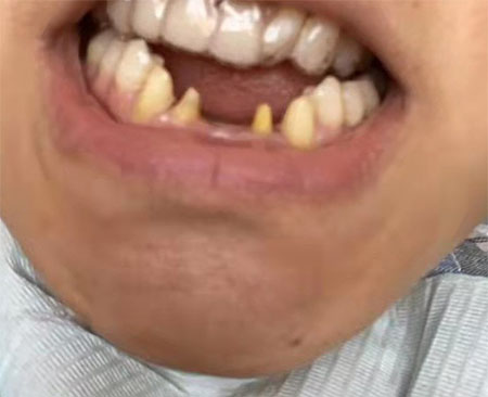 自貢新橋種植牙