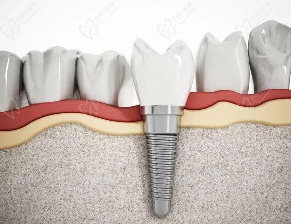 重慶牙博士口腔醫(yī)院種植科