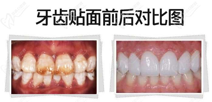 我做牙齒貼面5年后感受，看瓷貼面效果圖