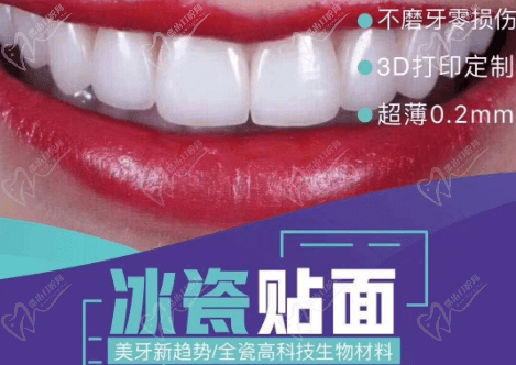 什么是冰瓷貼面？