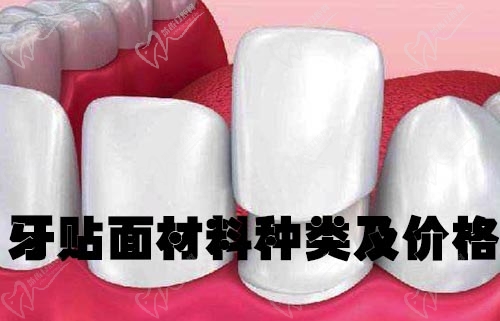 牙貼面材料種類(lèi)及價(jià)格