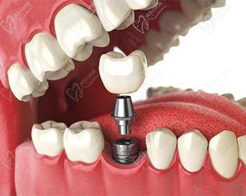 微創(chuàng)種植牙