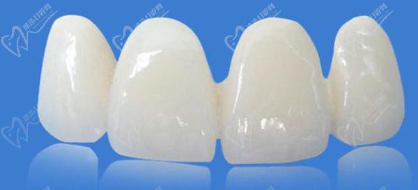 冰瓷牙和全瓷牙哪一個更好？看完冰瓷牙和全瓷牙的區(qū)別就明了