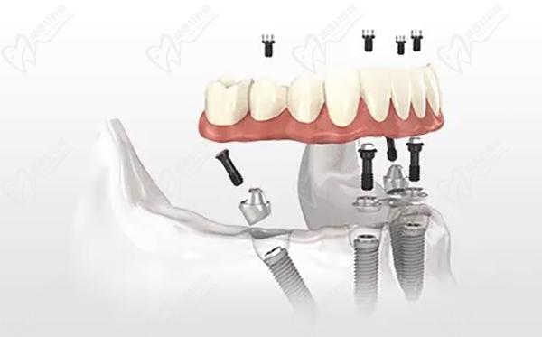 ALL-ON- 4即刻負(fù)重技術(shù)即拔即種