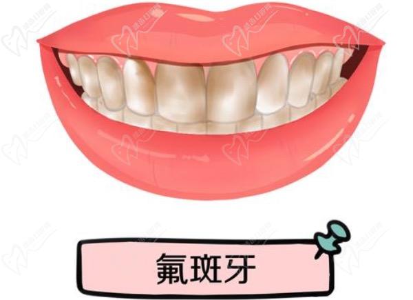 氟斑牙是什么原因造成的？