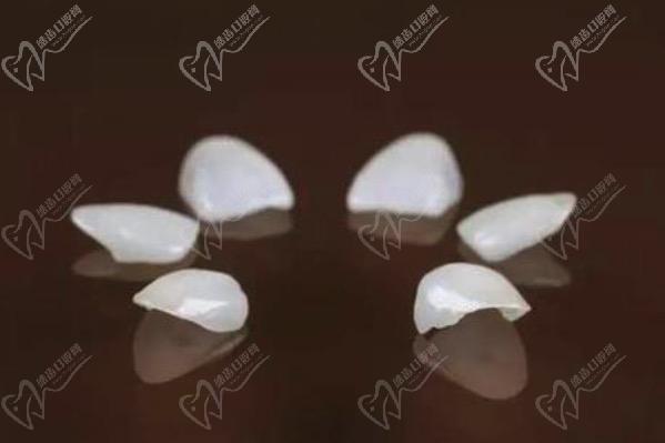 牙齒貼面多久可以做好？