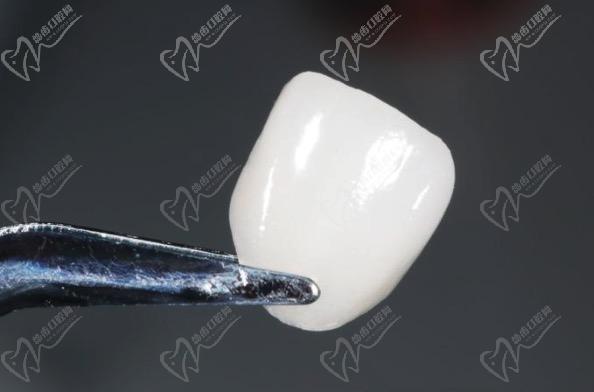 藍(lán)瓷貼面和鑄瓷貼面哪個(gè)好一點(diǎn)？