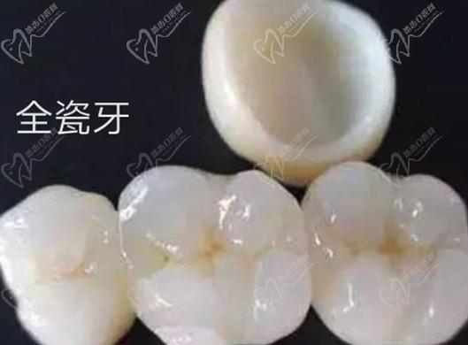 請問牙齒貼面跟全瓷冠的區(qū)別有哪些？