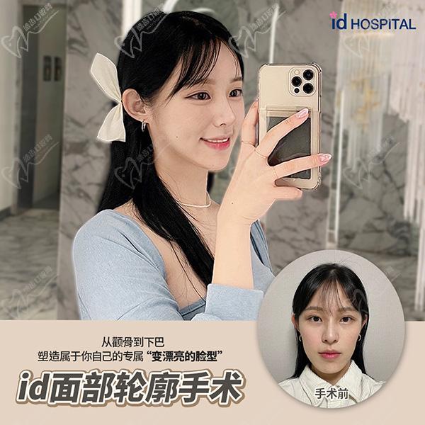 韓國(guó)id整形醫(yī)院面部輪廓手術(shù)術(shù)后圖