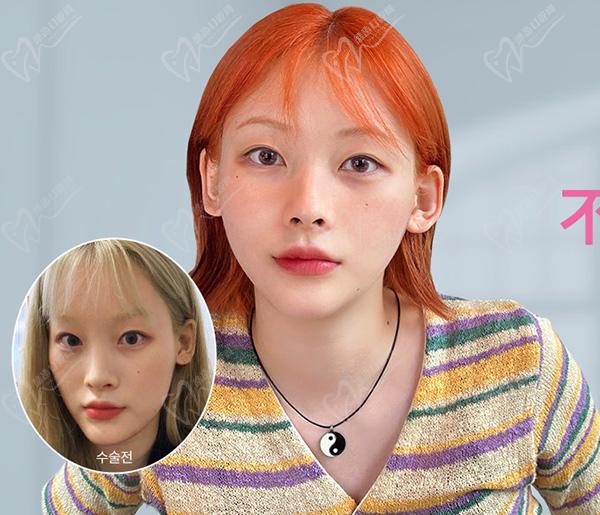 韓國(guó)id整形醫(yī)院雙鄂手術(shù)術(shù)后圖