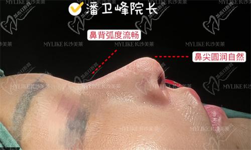 ,長(zhǎng)沙美萊潘衛(wèi)峰做個(gè)鼻子多少錢?