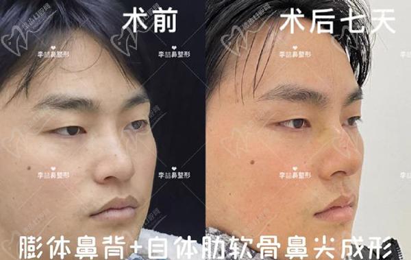 重慶李喆做鼻子怎么樣？口碑評(píng)價(jià)