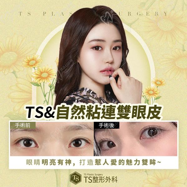 韓國ts整形雙眼皮手術圖片