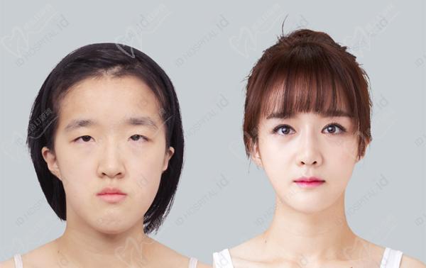 韓國id整形雙眼皮手術圖片