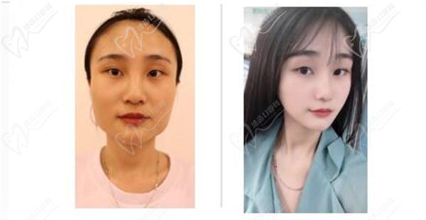 上海天壇普華整形醫(yī)院磨骨圖片