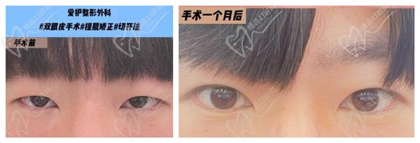 韓國(guó)愛護(hù)整形醫(yī)院眼修復(fù)