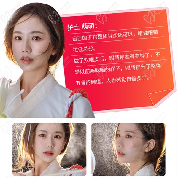 長(zhǎng)沙愛思特雙眼皮手術(shù)圖
