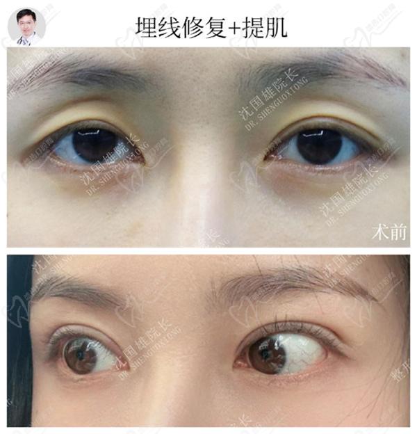 沈國雄眼修復(fù)真人實(shí)例圖