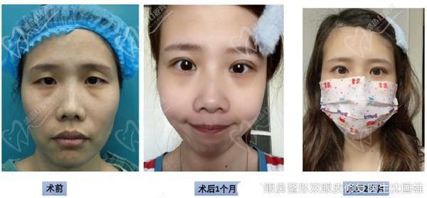沈國雄眼修復(fù)真人實(shí)例圖