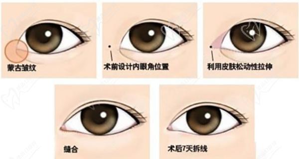雙眼皮