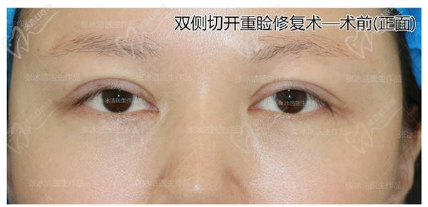 張冰潔雙眼皮修復(fù)案 例圖：肉條腫過(guò)寬過(guò)深、睜眼費(fèi)力眼睛無(wú)神