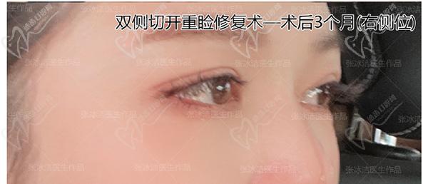 張冰潔雙眼皮修復(fù)案 例圖：肉條腫過(guò)寬過(guò)深、睜眼費(fèi)力眼睛無(wú)神