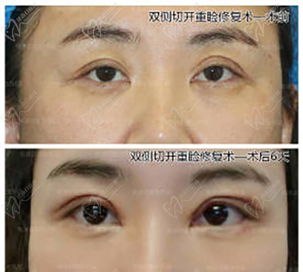 張冰潔雙眼皮修復(fù)案 例圖：不對(duì)稱、三角眼