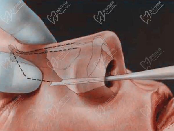 成都馮春雨做鼻子怎么樣技術(shù)如何