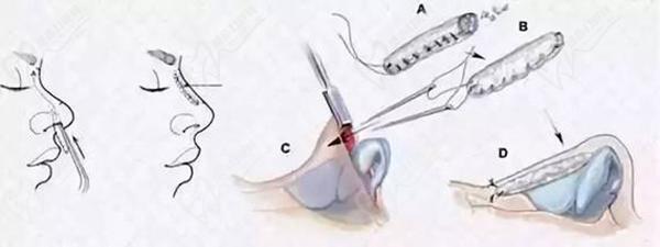 成都馮春雨做歪鼻矯正做得好嗎