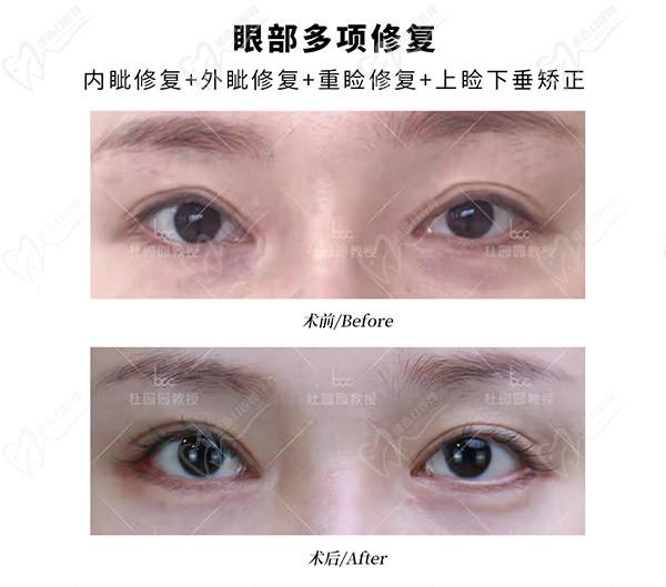 上海杜園園雙眼皮修復案 例圖片
