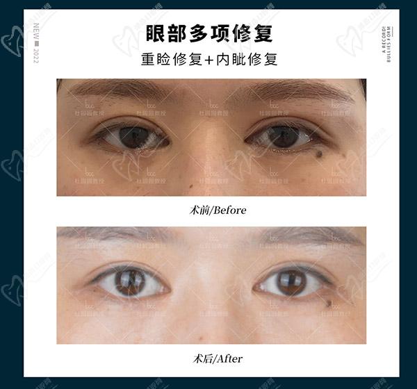 上海杜園園雙眼皮修復案 例圖片