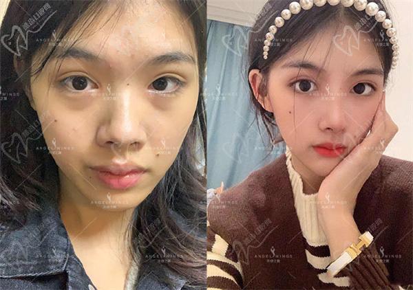 吳開泉隆鼻案 例圖片