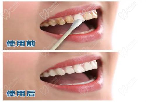 牙齒美白有哪些方法？