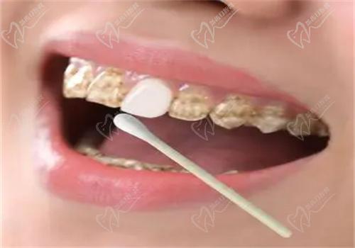 牙齒美白有哪些方法？