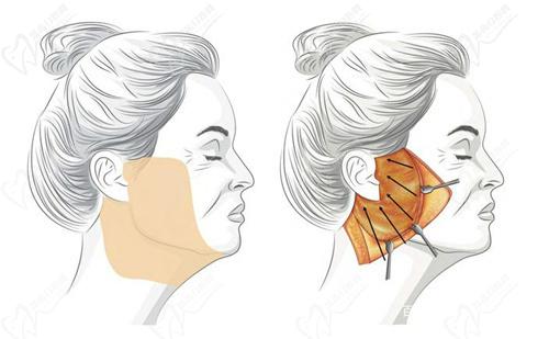 鄭州管城廣運醫(yī)療美容門診部魏廣運醫(yī)生技術怎么樣？