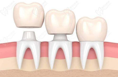 診所600一顆的愛爾創(chuàng)全瓷牙是真的嗎