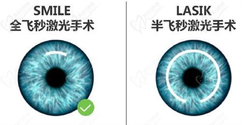 昆明近視手術(shù)哪家醫(yī)院好？
