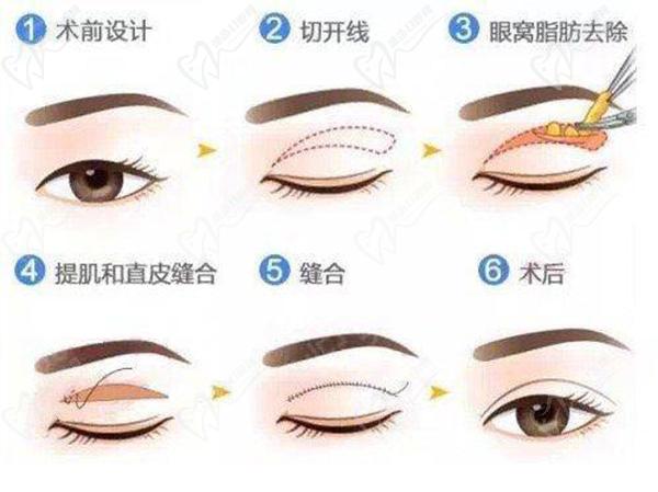 劉哲延雙眼皮