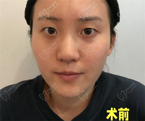 為什么選擇杜園園醫(yī)生做雙眼皮手術(shù)？