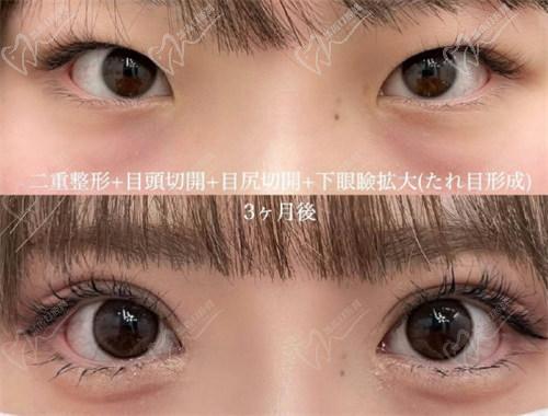 北京豐聯(lián)麗格醫(yī)療美容師麗麗修復(fù)雙眼皮怎么樣？