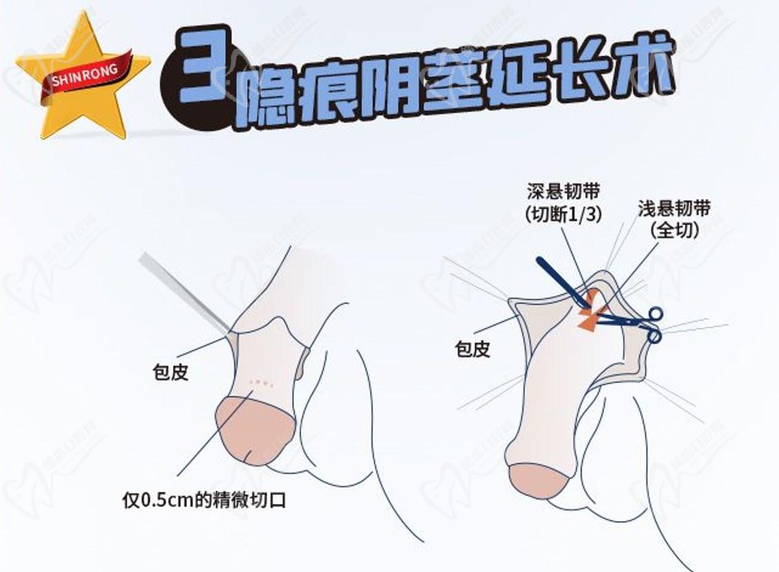 李世榮延長(zhǎng)手術(shù)之所以厲 害
