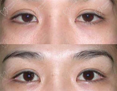 三、北京師麗麗雙眼皮修復與內(nèi)眼角修復的成功實例：