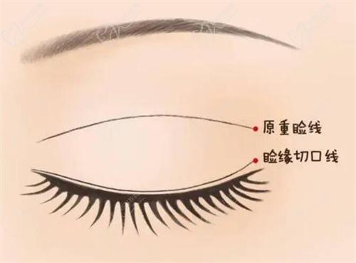 三、影響北京豐聯(lián)麗格整形醫(yī)院做雙眼皮價格的因素