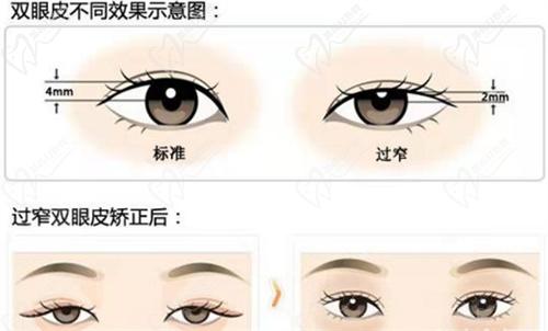 六、北京豐聯(lián)麗格整形醫(yī)院師麗麗醫(yī)生雙眼皮手術預約掛號方式