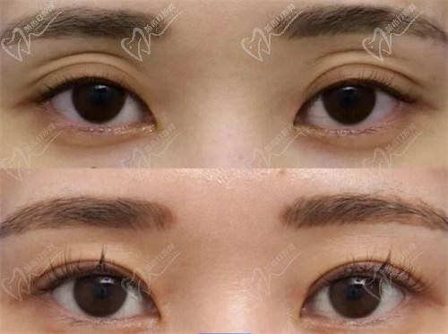 三、南京美萊王小林醫(yī)生手術(shù)特色與技術(shù)優(yōu)勢(shì)：