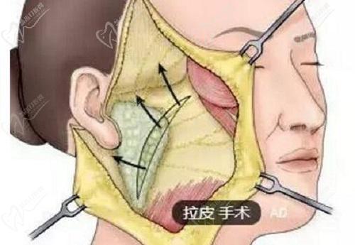 拉皮手術(shù)哪里的整容醫(yī)院做的好？