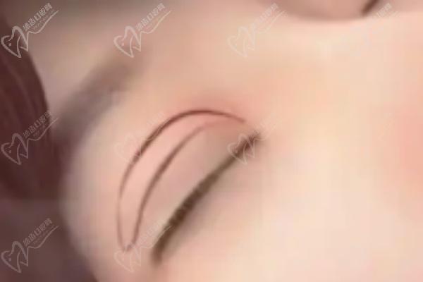 師麗麗雙眼皮修復(fù)手術(shù)項(xiàng)目?jī)?yōu)勢(shì)分析