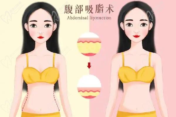 北京王陽(yáng)抽脂手術(shù)費(fèi)用一覽表