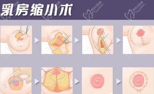 重慶劉正茂醫(yī)生縮胸怎么樣？