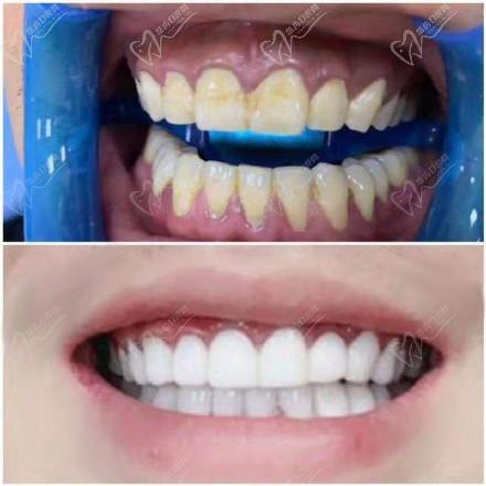 做牙貼面磨牙對牙齒的傷害大嗎？能維持多久呢？